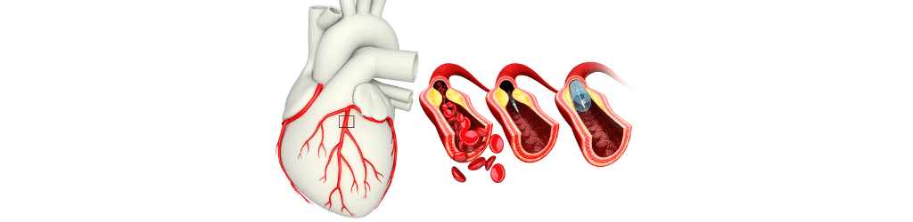 Can You Really Prevent Clogged Arteries? Here’s What You Need to Know - Dr Trust