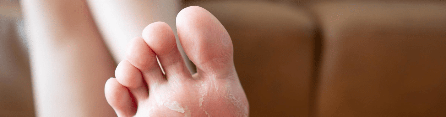 Foot Fungal Infection Woes During Monsoon: Simple Home Remedies For Effective Relief - Dr Trust